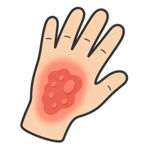 Piktogram AAC: oparzenie