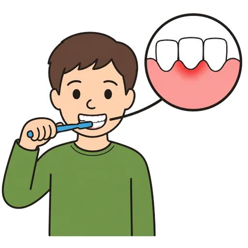 Pictograma CAA: Inflamación de la encía